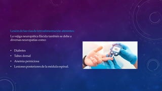 Lesióndelasvíasderetroalimentación aferentes:
La vejiga neuropática flácida también se debe a
diversas neuropatías como:
• Diabetes
• Tabes dorsal
• Anemia perniciosa
• Lesionesposterioresde la médulaespinal.
 