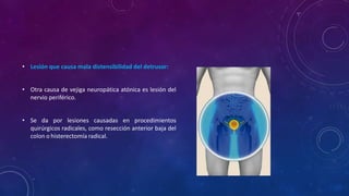 • Lesión que causa mala distensibilidad del detrusor:
• Otra causa de vejiga neuropática atónica es lesión del
nervio periférico.
• Se da por lesiones causadas en procedimientos
quirúrgicos radicales, como resección anterior baja del
colon o histerectomía radical.
 
