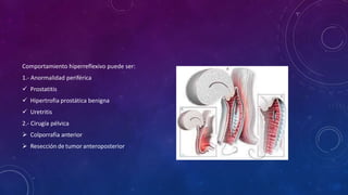 Comportamiento hiperreflexivo puede ser:
1.- Anormalidad periférica
 Prostatitis
 Hipertrofia prostática benigna
 Uretritis
2.- Cirugía pélvica
 Colporrafia anterior
 Resección de tumor anteroposterior
 