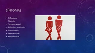 SÍNTOMAS
• Polaquiuria
• Nicturia
• Tenesmo vesical
• Dificultad para iniciar
• Intermitencia
• Doble micción
• Orina residual
 