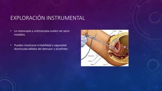 EXPLORACIÓN INSTRUMENTAL
• La cistoscopia y uretroscopia suelen ser poco
notables.
• Pueden mostrarse irritabilidad y capacidad
disminuida débiles del detrusor y el esfínter.
 