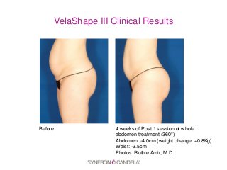 VelaShape III Clinical Results
Before 4 weeks of Post 1 session of whole
abdomen treatment (360°)
Abdomen: -4.0cm (weight change: +0.8Kg)
Waist: -3.5cm
Photos: Ruthie Amir, M.D.
 