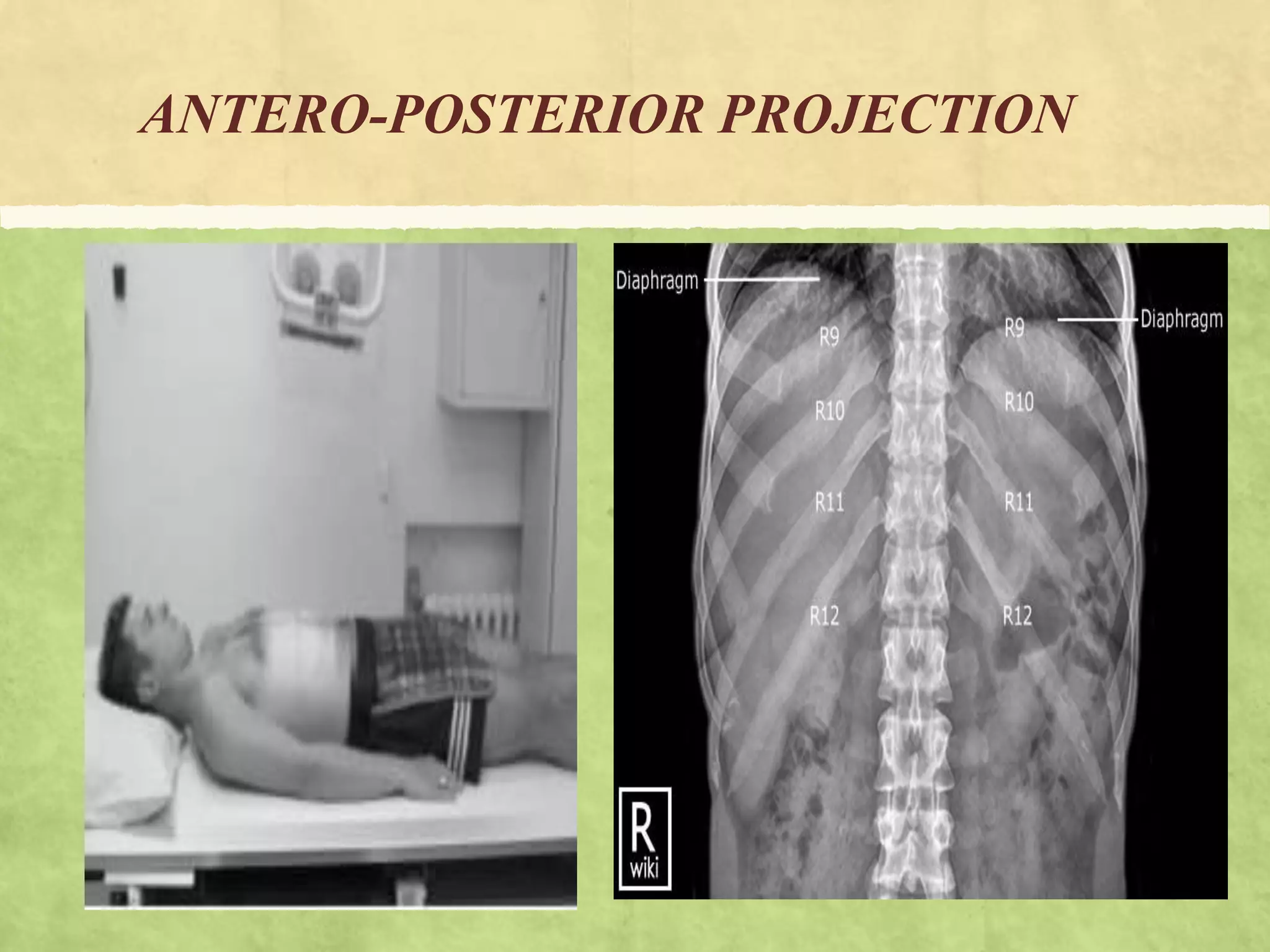 RIBS AND STERNUM RADIO-GRAPHIC PROJECTIONS | PPTX