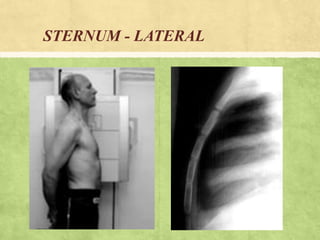 Sternum Radiography Positioning RIBS AND STERNUM RADIO-GRAPHIC PROJECTIONS | PPTX