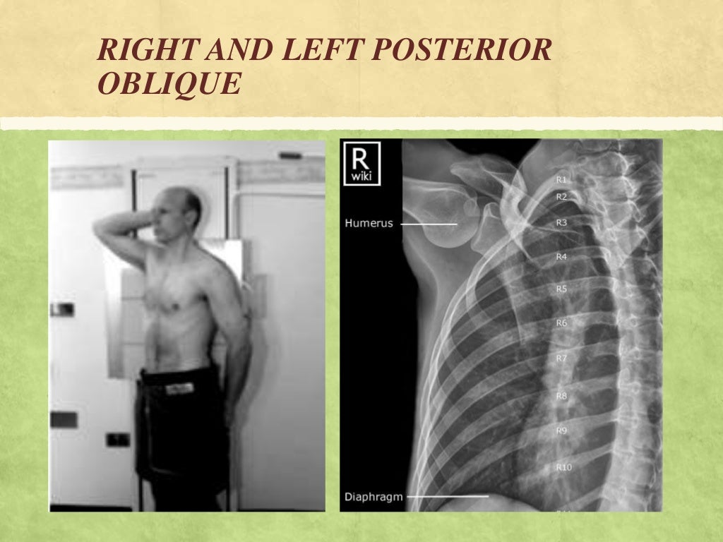 RIBS AND STERNUM RADIOGRAPHIC PROJECTIONS