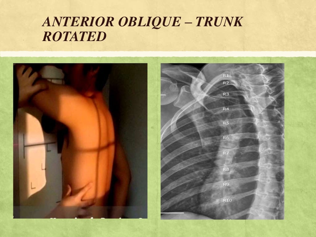 RIBS AND STERNUM RADIOGRAPHIC PROJECTIONS
