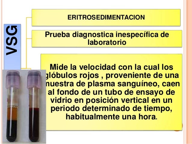 Velocidad de segmentacion globular