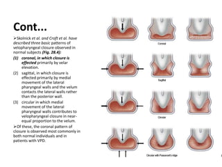 Cont...
Skolnick et al. and Croft et al. have
described three basic patterns of
velopharyngeal closure observed in
normal subjects (Fig. 28.4):
(1) coronal, in which closure is
effected primarily by velar
elevation.
(2) sagittal, in which closure is
effected primarily by medial
movement of the lateral
pharyngeal walls and the velum
contacts the lateral walls rather
than the posterior wall.
(3) circular in which medial
movement of the lateral
pharyngeal walls contributes to
velopharyngeal closure in near-
equal proportion to the velum.
Of these, the coronal pattern of
closure is observed most commonly in
both normal individuals and in
patients with VPD.
 