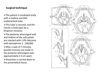 Surgical technique
The patient is intubated orally
with a midline oral RAE
endotracheal tube.
This tube is secured, and the
mouth is held open by a
Dingman retractor.
The posterior pharyngeal wall
and midline of the soft palate
are injected with 1.0% lidocaine
with epinephrine 1 : 100,000.
After a wait of 7 minutes,
parallel incisions are made in
the posterior pharyngeal wall,
approximately 2.5 cm apart.
Dissection is carried down to
the prevertebral fascia.
 