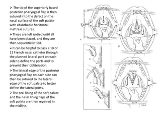  The tip of the superiorly based
posterior pharyngeal flap is then
sutured into the defect on the
nasal surface of the soft palate
with absorbable horizontal
mattress sutures.
These are left untied until all
have been placed, and they are
then sequentially tied.
It can be helpful to pass a 10 or
12 French nasal catheter through
the planned lateral port on each
side to define the ports and to
prevent their obliteration.
The lateral edge of the posterior
pharyngeal flap on each side can
then be sutured to the lateral
edge of the soft palate to better
define the lateral ports.
The oral lining of the soft palate
and the nasal lining flaps of the
soft palate are then repaired in
the midline.
 