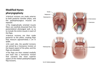 Modified Hynes
pharyngoplasty
Vertical incisions are made anterior
to both posterior tonsillar pillars, and
the palatopharyngeus muscles are
exposed.
The longitudinally oriented muscle
fibers are carefully dissected from the
posterolateral pharyngeal wall, so as
to include the entire muscle in each of
the flaps.
Vertical incisions are then made
posterior to the pillars, creating flaps
that measure approximately 1 cm in
width.
On each side, the parallel incisions
are joined by a transverse incision at
the lowest aspect of the pillar, and the
flaps are elevated.
The flaps are then rotated medially
and inset into a transverse incision
that connects the most superior
aspect of the medial palatopharyngeal
flap incisions.
 