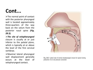 Cont...
The normal point of contact
with the posterior pharyngeal
wall is located approximately
three-quarters of the way
back on the velum from the
posterior nasal spine (Fig.
28.3).
The site of velopharyngeal
closure is usually at or just
inferior to the palatal plane,
which is typically at or above
the level of the first cervical
vertibrae.
Maximal lateral pharyngeal
wall displacement generally
occurs at the level of
velopharyngeal contact.
 