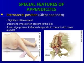 Comprehensive Overview of Vermiform Appendix and Acute Appendicitis ...
