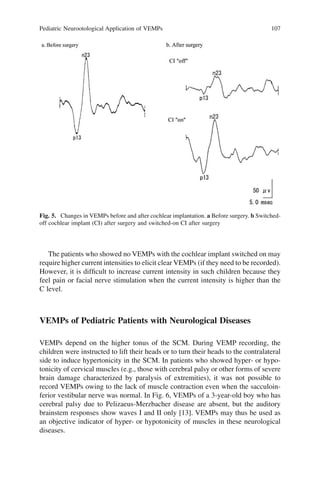 Pediatric Neurootological Application of VEMPs 107
Fig. 5. Changes in VEMPs before and after cochlear implantation. a Before surgery. b Switched-
off cochlear implant (CI) after surgery and switched-on CI after surgery
The patients who showed no VEMPs with the cochlear implant switched on may
require higher current intensities to elicit clear VEMPs (if they need to be recorded).
However, it is difﬁcult to increase current intensity in such children because they
feel pain or facial nerve stimulation when the current intensity is higher than the
C level.
VEMPs of Pediatric Patients with Neurological Diseases
VEMPs depend on the higher tonus of the SCM. During VEMP recording, the
children were instructed to lift their heads or to turn their heads to the contralateral
side to induce hypertonicity in the SCM. In patients who showed hyper- or hypo-
tonicity of cervical muscles (e.g., those with cerebral palsy or other forms of severe
brain damage characterized by paralysis of extremities), it was not possible to
record VEMPs owing to the lack of muscle contraction even when the sacculoin-
ferior vestibular nerve was normal. In Fig. 6, VEMPs of a 3-year-old boy who has
cerebral palsy due to Pelizaeus-Merzbacher disease are absent, but the auditory
brainstem responses show waves I and II only [13]. VEMPs may thus be used as
an objective indicator of hyper- or hypotonicity of muscles in these neurological
diseases.
 