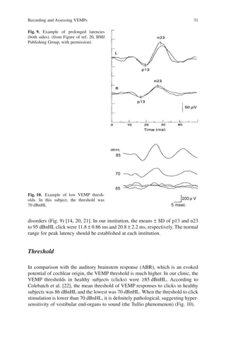 disorders (Fig. 9) [14, 20, 21]. In our institution, the means ± SD of p13 and n23
to 95 dBnHL click were 11.8 ± 0.86 ms and 20.8 ± 2.2 ms, respectively. The normal
range for peak latency should be established at each institution.
Threshold
In comparison with the auditory brainstem response (ABR), which is an evoked
potential of cochlear origin, the VEMP threshold is much higher. In our clinic, the
VEMP thresholds in healthy subjects (clicks) were ≥85 dBnHL. According to
Colebatch et al. [22], the mean threshold of VEMP responses to clicks in healthy
subjects was 86 dBnHL and the lowest was 70 dBnHL. When the threshold to click
stimulation is lower than 70 dBnHL, it is deﬁnitely pathological, suggesting hyper-
sensitivity of vestibular end-organs to sound (the Tullio phenomenon) (Fig. 10).
Fig. 9. Example of prolonged latencies
(both sides). (from Figure of ref. 20, BMJ
Publishing Group, with permission)
Fig. 10. Example of low VEMP thresh-
olds. In this subject, the threshold was
70 dBnHL
Recording and Assessing VEMPs 31
 