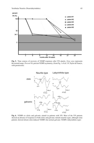 Vestibular Neuritis (Neurolabyrinthitis) 65
Fig. 5. Time courses of recovery of VEMP responses after VN attacks. Gray area represents
the normal range. Percent VA, percent VEMP asymmetry. (from Fig. 1 of ref. 19, Taylor & Francis,
with permission)
Neuritis type Labyrinthitis type
click
galvanic
Fig. 6. VEMPs to clicks and galvanic stimuli in patients with VN. Most of the VN patients
showed an absence of responses to both clicks and galvanic stimuli (neuritis type), although some
patients showed absent click-induced VEMPs but normal galvanic VEMPs (labyrinthitis type)
 