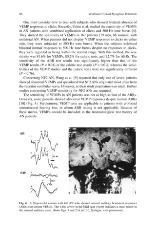86 Vestibular Evoked Myogenic Potentials
One must consider how to deal with subjects who showed bilateral absence of
VEMP responses to clicks. Recently, Ushio et al. studied the sensitivity of VEMPs
in AN patients with combined application of clicks and 500-Hz tone bursts [4].
They studied the sensitivity of VEMPs in 167 patients (79 men, 88 women) with
unilateral AN. When patients did not display VEMP responses to clicks on either
side, they were subjected to 500-Hz tone bursts. When the subjects exhibited
bilateral normal responses to 500-Hz tone bursts despite no responses to clicks,
they were regarded as being within the normal range. With this method, the sen-
sitivity was 81.6% for VEMPs, 80.2% for caloric tests, and 92.7% for ABRs. The
sensitivity of the ABR test results was signiﬁcantly higher than that of the
VEMP results (P < 0.01) or the caloric test results (P < 0.01); whereas the sensi-
tivities of the VEMP studies and the caloric tests were not signiﬁcantly different
(P = 0.76).
Concerning NF2 AN, Wang et al. [9] reported that only one of seven patients
showed abnormal VEMPs and speculated that NF2 ANs originated most often from
the superior vestibular nerve. However, as their study population was small, further
studies concerning VEMP sensitivity for NF2 ANs are required.
The sensitivity of VEMPs in AN patients was not as high as that of the ABRs.
However, some patients showed abnormal VEMP responses despite normal ABRs
[10] (Fig. 4). Furthermore, VEMP tests are applicable to patients with profound
sensorineural hearing loss, in whom ABR testing is not applicable. Because of
these merits, VEMPs should be included in the neurootological test battery of
AN patients.
Fig. 4. A 58-year-old woman with left AN who showed normal auditory brainstem responses
(ABRs) but absent VEMPs. The white arrow in the MRI scan (right) indicates a small tumor in
the internal auditory canal. (from Figs. 1 and 2 of ref. 10, Springer, with permission)
 