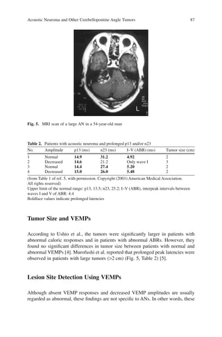 Acoustic Neuroma and Other Cerebellopontine Angle Tumors 87
Tumor Size and VEMPs
According to Ushio et al., the tumors were signiﬁcantly larger in patients with
abnormal caloric responses and in patients with abnormal ABRs. However, they
found no signiﬁcant differences in tumor size between patients with normal and
abnormal VEMPs [4]. Murofushi et al. reported that prolonged peak latencies were
observed in patients with large tumors (>2 cm) (Fig. 5, Table 2) [5].
Lesion Site Detection Using VEMPs
Although absent VEMP responses and decreased VEMP amplitudes are usually
regarded as abnormal, these ﬁndings are not speciﬁc to ANs. In other words, these
Fig. 5. MRI scan of a large AN in a 54-year-old man
Table 2. Patients with acoustic neuroma and prolonged p13 and/or n23
No. Amplitude p13 (ms) n23 (ms) I–V (ABR) (ms) Tumor size (cm)
1 Normal 14.9 31.2 4.92 2
2 Decreased 14.6 21.2 Only wave I 3
3 Normal 14.4 27.4 5.20 2
4 Decreased 15.0 26.0 5.48 2
(from Table 1 of ref. 5, with permission. Copyright (2001) American Medical Association.
All rights reserved)
Upper limit of the normal range: p13, 13.5; n23, 25.2; I–V (ABR), interpeak intervals between
waves I and V of ABR: 4.4
Boldface values indicate prolonged latencies
 