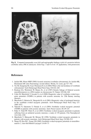 90 Vestibular Evoked Myogenic Potentials
References
1. Jackler RK, Pﬁster MHF (2005) Acoustic neuroma (vestibular schwannoma). In: Jackler RK,
Brackmann DE (eds) Neurotology second edition. Mosby, St. Louis, pp 727–782
2. Tos M, Stangerup SE, Caye-Thomasen P, et al (2004) What is the real incidence of vestibular
schwannoma? Arch Otolaryngol Head Neck Surg 130:216–220
3. Rouleau GA, Wertelecki W, Haines JL, et al (1987) Genetic linkage of bilateral acoustic
neuroﬁbromatosis to a DNA marker on chromosome 22. Nature 329:246–248
4. Ushio M, Murofushi T, Iwasaki S, et al (2008) Diagnostic value of vestibular evoked myo-
genic potentials (VEMPs) in patients with acoustic neuroma. In: 25th Barany meeting
abstracts
5. Murofushi T, Shimizu K, Takegoshi H, et al (2001) Diagnostic value of prolonged latencies
in the vestibular evoked myogenic potentials. Arch Otolaryngol Head Neck Surg 127:
1069–1072
6. Takeichi N, Sakamoto T, Fukuda S, et al (2001) Vestibular evoked myogenic potential
(VEMP) in patients with acoustic neuromas. Auris Nasus Larynx 28:s39–s41
7. Patko T, Vidal PP, Vibert N, et al (2003) Vestibular evoked myogenic potentials in patients
suffering from an unilateral acoustic neuroma: a study of 170 patients. Clin Neurophysiol
114:1344–1350
8. Murofushi T, Matsuzaki M, Mizuno M (1998) Vestibular evoked myogenic potentials in
patients with acoustic neuromas. Arch Otolaryngol Head Neck Surg 124:509–512
9. Wang CP, Hsu WC, Young YH (2005) Vestibular evoked myogenic potentials in neuroﬁbro-
matosis 2. Ann Otol Rhinol Laryngol 114:69–73
Fig. 8. Computed tomography scan (left) and angiographic ﬁndings (right) of a posterior inferior
cerebellar artery (PICA) aneurysm. (from Figs. 3 and 4 of ref. 19, Igakushoin, with permission)
 