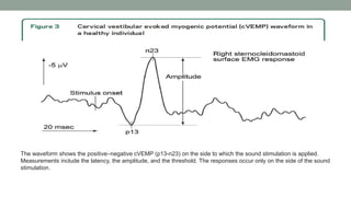 Cvemp Example Vestibular evoked myogenic potential seminar | PPTX