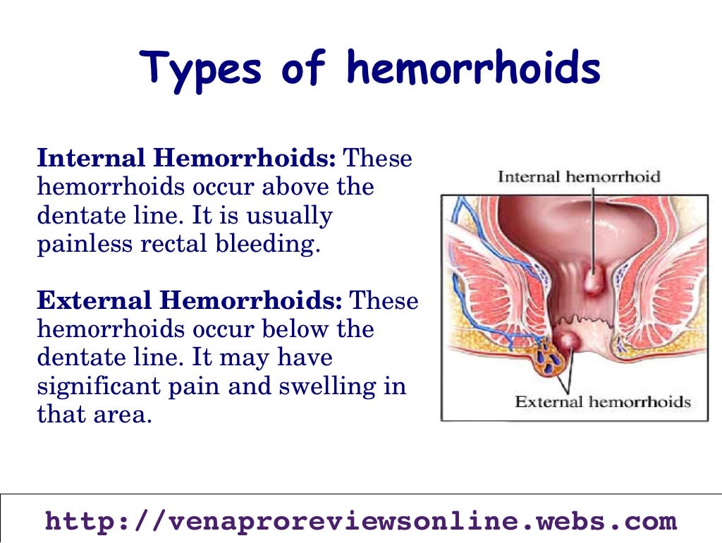Venapro for any internal or external hemorrhoids problems