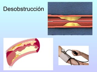 Desobstrucción  