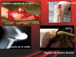 Fractura expuesta de la tibia Herida de la pierna derecha
Luxación de la rodilla
Esguince del hombro derecho
 