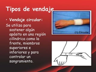 Tipos de vendaje
• Vendaje circular:
Se utiliza para
sostener algún
apósito en una región
cilíndrica como la
frente, miembros
superiores e
inferiores y para
controlar un
sangramiento.
 