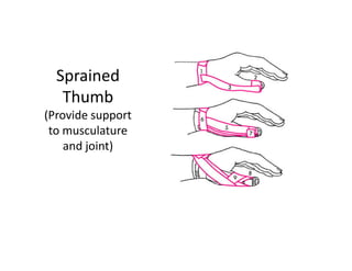 Sprained
Thumb
(Provide support
to musculatureto musculature
and joint)
 