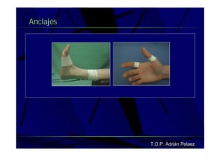 Vendaje Funcional Miembro Superior