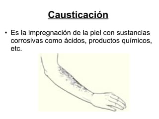 Causticación   Es la impregnación de la piel con sustancias corrosivas como ácidos, productos químicos, etc. 