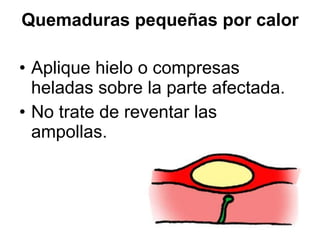 Quemaduras pequeñas por calor Aplique hielo o compresas heladas sobre la parte afectada.  No trate de reventar las ampollas.  