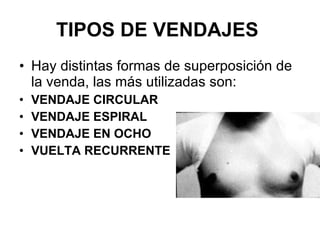 TIPOS DE VENDAJES   Hay distintas formas de superposición de la venda, las más utilizadas son:  VENDAJE CIRCULAR   VENDAJE ESPIRAL VENDAJE EN OCHO VUELTA RECURRENTE  