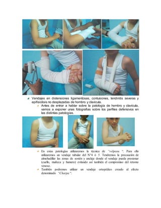 Vendajes en distensiones ligamentosas, contusiones, tendinitis severas y
epifisiolisis no desplazadas de hombro y clavicula.
Antes de entrar a hablar sobre la patología de hombro y clavícula,
vamos a exponer unas fotografias sobre los perfiles defensivos en
las distintas patologías.
En estas patologías utilizaremos la técnica de “velpeau “. Para ello
utilizaremos un vendaje tubular del N°4 ó 5. Tendremos la precaución de
almohadillar las zonas de sostén y anclaje donde el vendaje pueda presionar
(cuello, muñeca y humero) evitando así también el compromiso del retomo
venoso.
También podremos utilizar un vendaje ortopédico creado al efecto
denominado “Charpa “.
 
