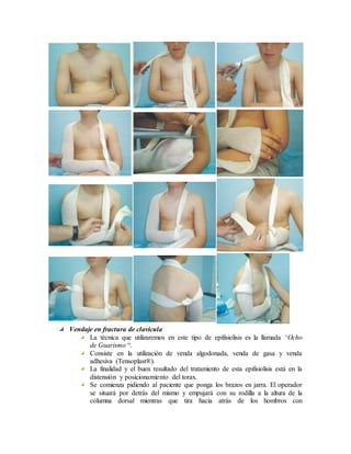 Vendaje en fractura de clavícula
La técnica que utilizaremos en este tipo de epifisiolisis es la llamada “Ocho
de Guarismo “.
Consiste en la utilización de venda algodonada, venda de gasa y venda
adhesiva (Tensoplast®).
La finalidad y el buen resultado del tratamiento de esta epifisiolisis está en la
distensión y posicionamiento del torax.
Se comienza pidiendo al paciente que ponga los brazos en jarra. El operador
se situará por detrás del mismo y empujará con su rodilla a la altura de la
columna dorsal mientras que tira hacia atrás de los hombros con
 