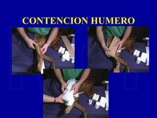 CONTENCION HUMERO
 