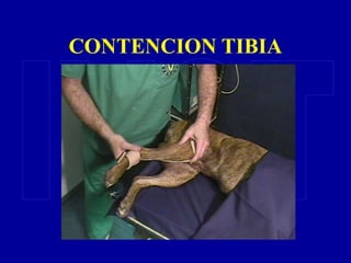 CONTENCION TIBIA
 