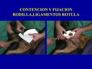 CONTENCION Y FIJACION
RODILLA,LIGAMENTOS ROTULA
 