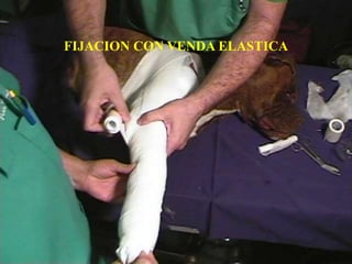 FIJACION CON VENDA ELASTICA
 