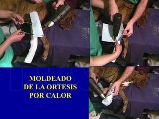 MOLDEADO
DE LA ORTESIS
POR CALOR
 