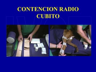 CONTENCION RADIO
CUBITO
 