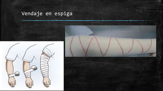 Vendaje en espiga
 