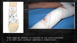 Este tipo de vendaje se utiliza en las articulaciones
y es útil para sostener apósitos e inmovilizar.
 