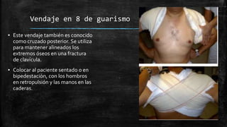 Vendaje en 8 de guarismo
▪ Este vendaje también es conocido
como cruzado posterior. Se utiliza
para mantener alineados los
extremos óseos en una fractura
de clavícula.
▪ Colocar al paciente sentado o en
bipedestación, con los hombros
en retropulsión y las manos en las
caderas.
 
