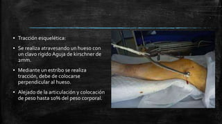 ▪ Tracción esquelética:
▪ Se realiza atravesando un hueso con
un clavo rígido Aguja de kirschner de
2mm.
▪ Mediante un estribo se realiza
tracción, debe de colocarse
perpendicular al hueso.
▪ Alejado de la articulación y colocación
de peso hasta 10% del peso corporal.
 