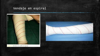 Vendaje en espiral
 