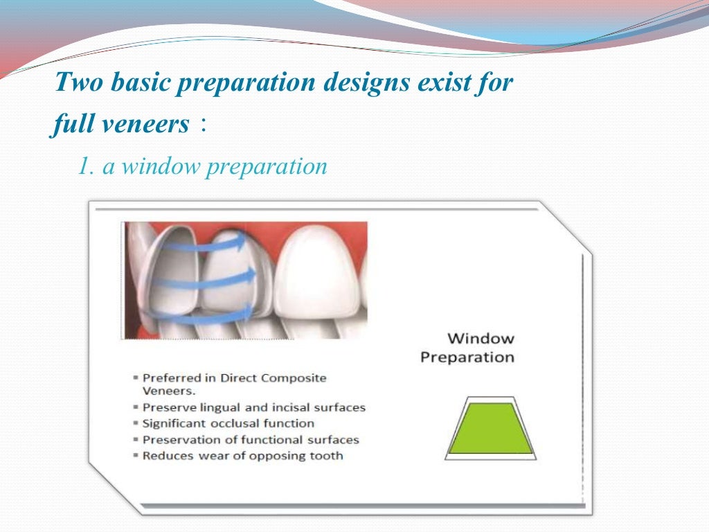 direct and indirect Veneer