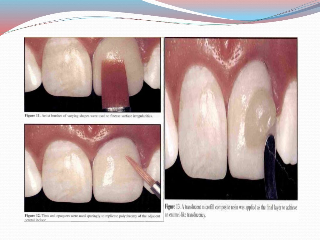 direct and indirect Veneer