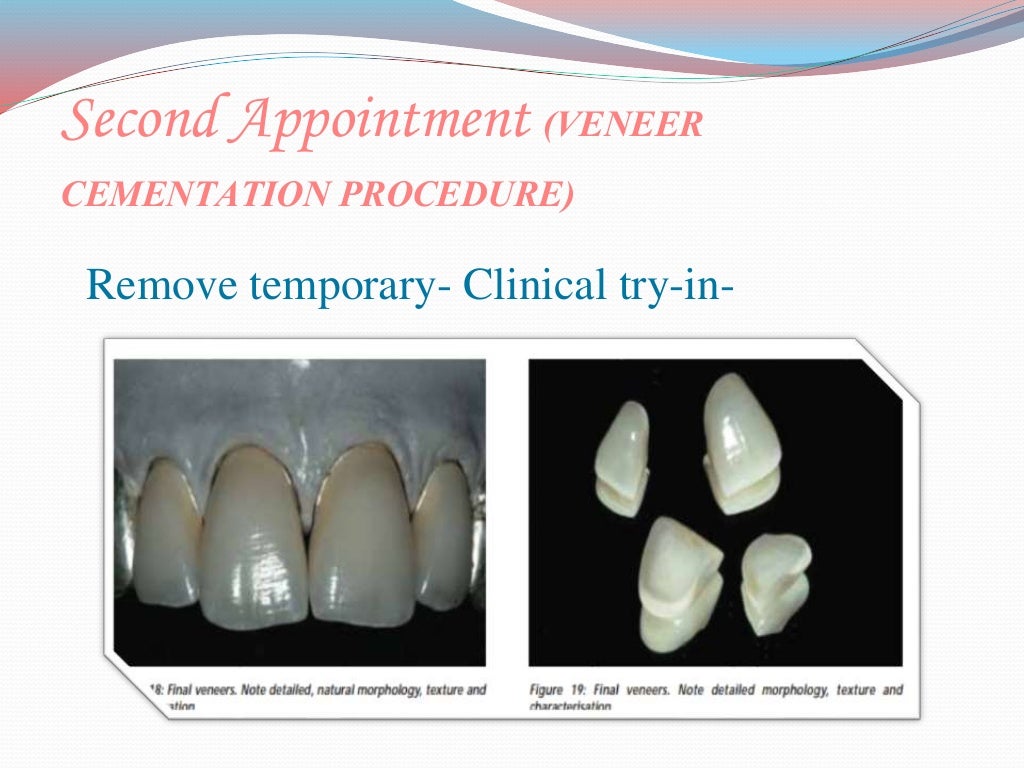 direct and indirect Veneer