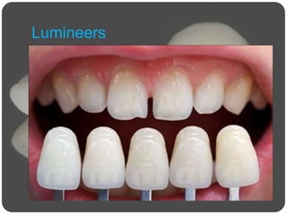 Lumineers
 When placing lumineers, the structure of the tooth
remains unchanged.
 Are as thick as a contact lens, but this does not
make them less durable.
 Might feel a little bulkier than the classic porcelain
veneers.
 The tooth is still protected by its natural enamel,
even if the lumineers need to be taken off.
 In terms of costs, lumineers have similar costs as
the porcelain veneers.
 